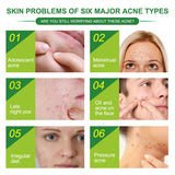 Acne Pimple Removal Patch 24 Patches