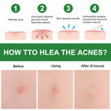 Acne Pimple Removal Patch 24 Patches